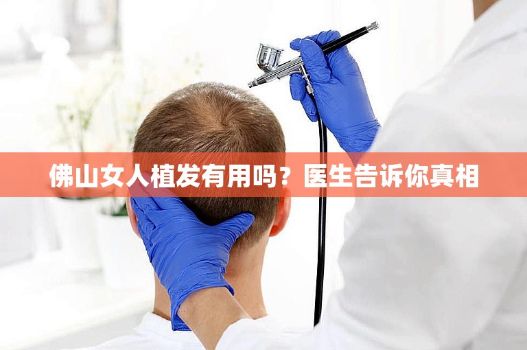 佛山女人植发有用吗？医生告诉你真相