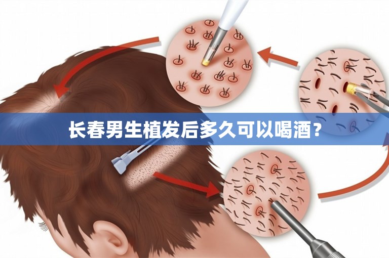 长春男生植发后多久可以喝酒？