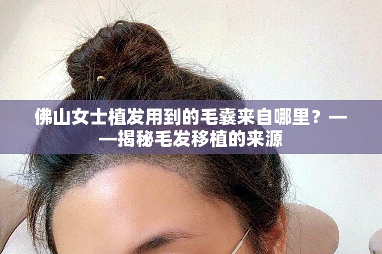 佛山女士植发用到的毛囊来自哪里？——揭秘毛发移植的来源