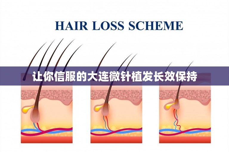 让你信服的大连微针植发长效保持