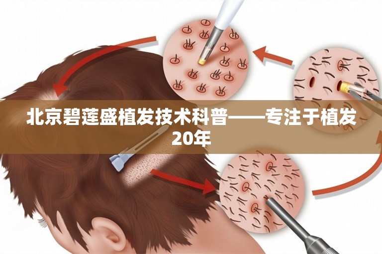 北京碧莲盛植发技术科普——专注于植发20年