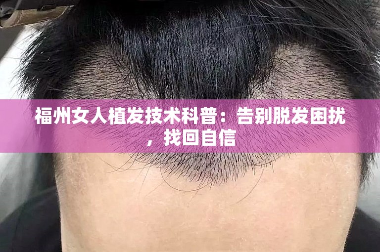 福州女人植发技术科普：告别脱发困扰，找回自信