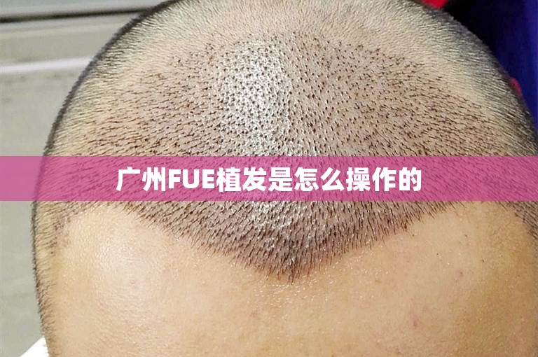 广州FUE植发是怎么操作的