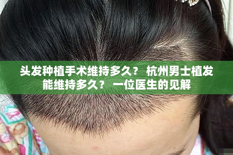 头发种植手术维持多久？ 杭州男士植发能维持多久？ 一位医生的见解