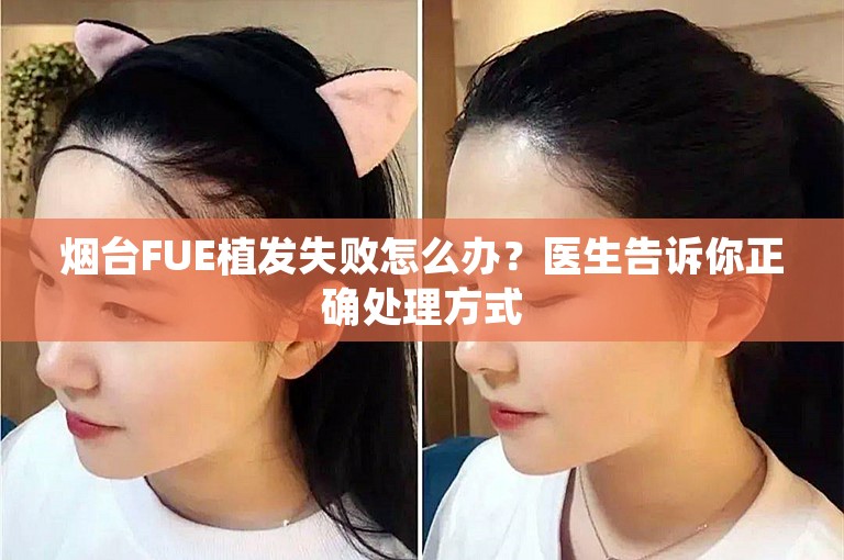 烟台FUE植发失败怎么办？医生告诉你正确处理方式