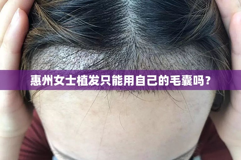 惠州女士植发只能用自己的毛囊吗？