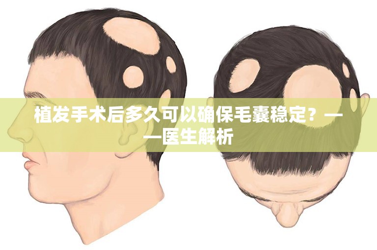 植发手术后多久可以确保毛囊稳定？——医生解析