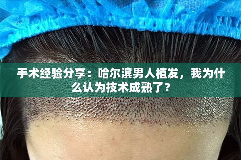 手术经验分享：哈尔滨男人植发，我为什么认为技术成熟了？