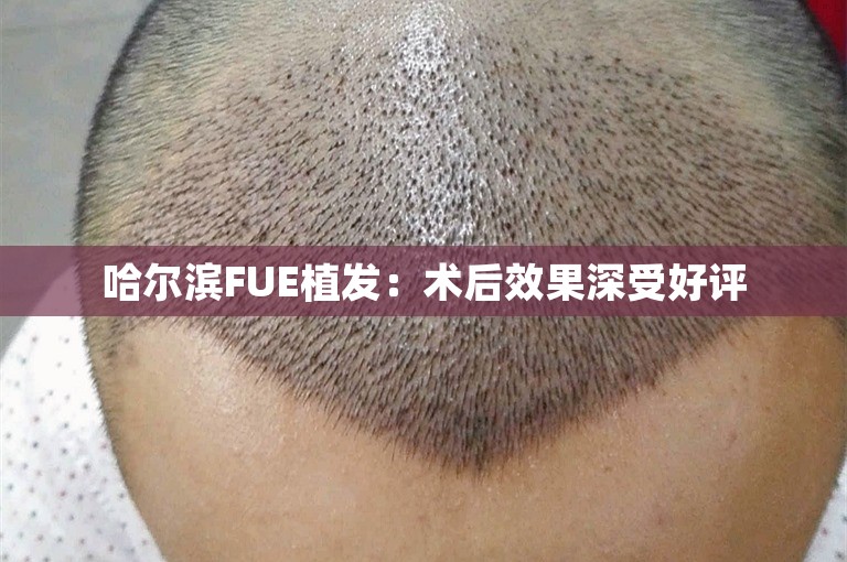 哈尔滨FUE植发：术后效果深受好评