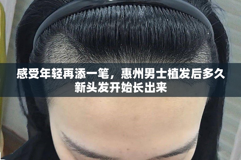 感受年轻再添一笔，惠州男士植发后多久新头发开始长出来