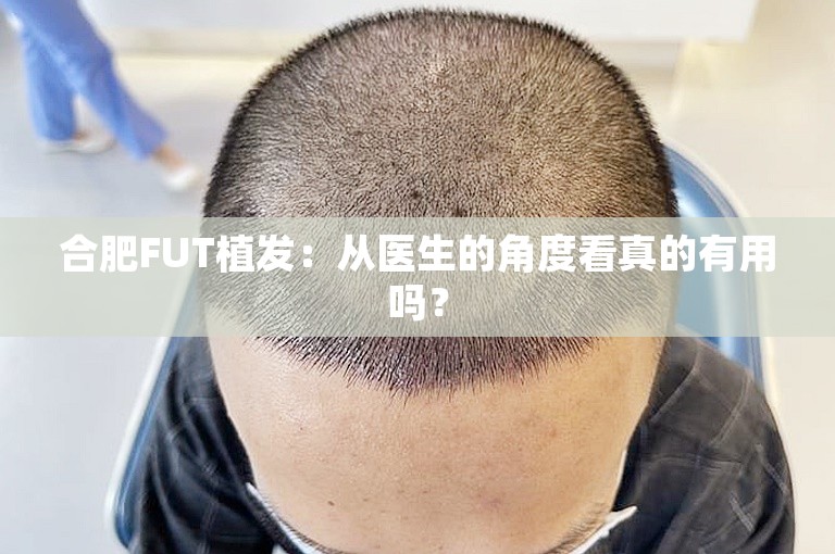 合肥FUT植发：从医生的角度看真的有用吗？