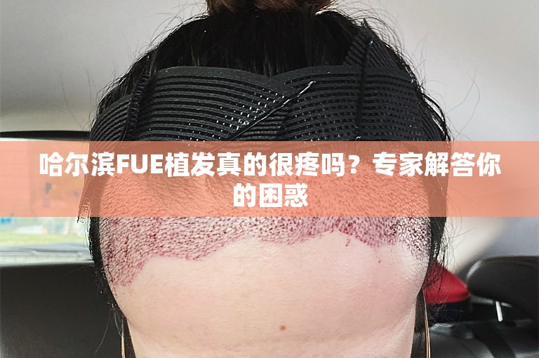 哈尔滨FUE植发真的很疼吗？专家解答你的困惑