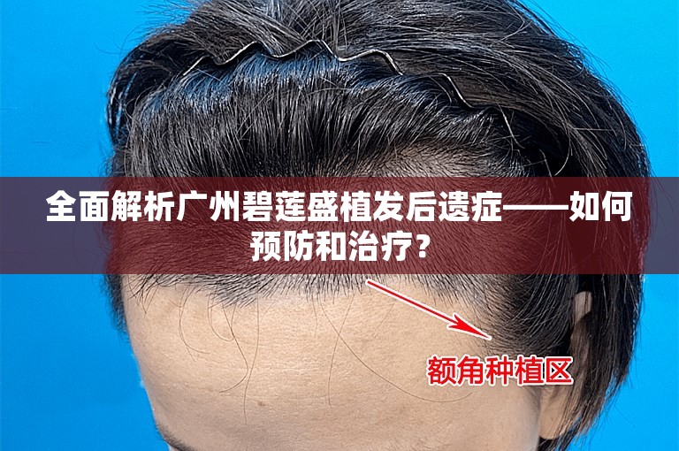 全面解析广州碧莲盛植发后遗症——如何预防和治疗？