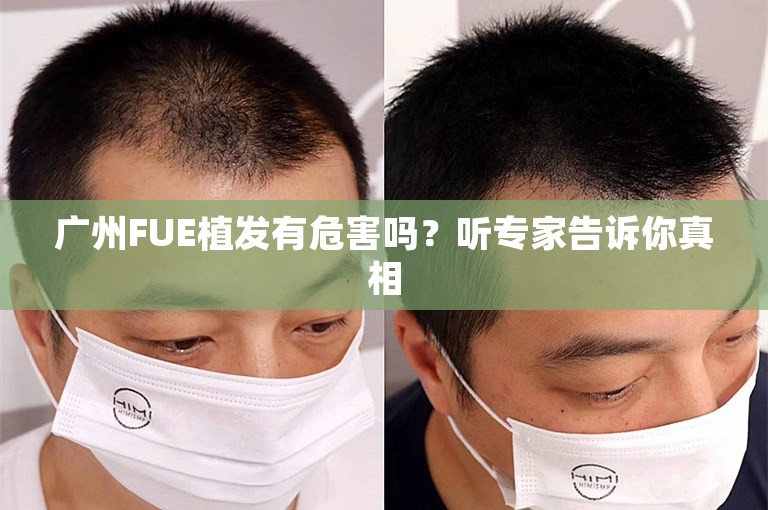 广州FUE植发有危害吗？听专家告诉你真相