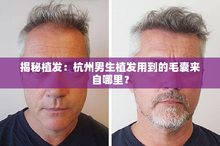 揭秘植发：杭州男生植发用到的毛囊来自哪里？