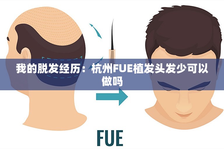 我的脱发经历：杭州FUE植发头发少可以做吗