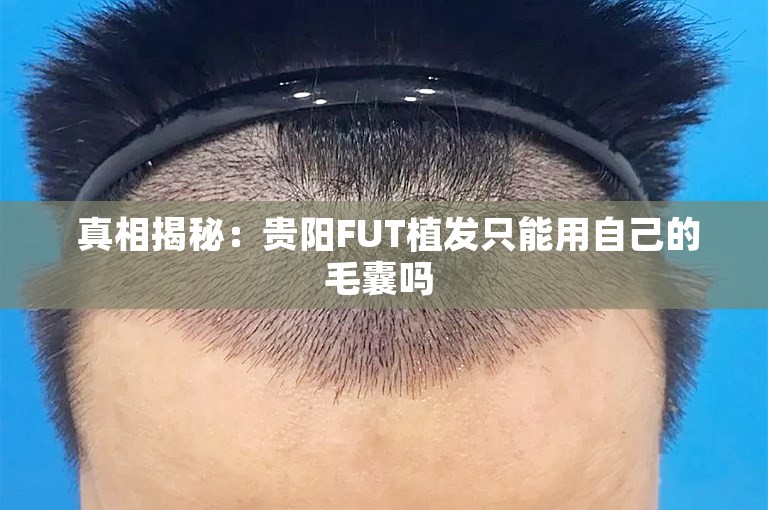  真相揭秘：贵阳FUT植发只能用自己的毛囊吗 