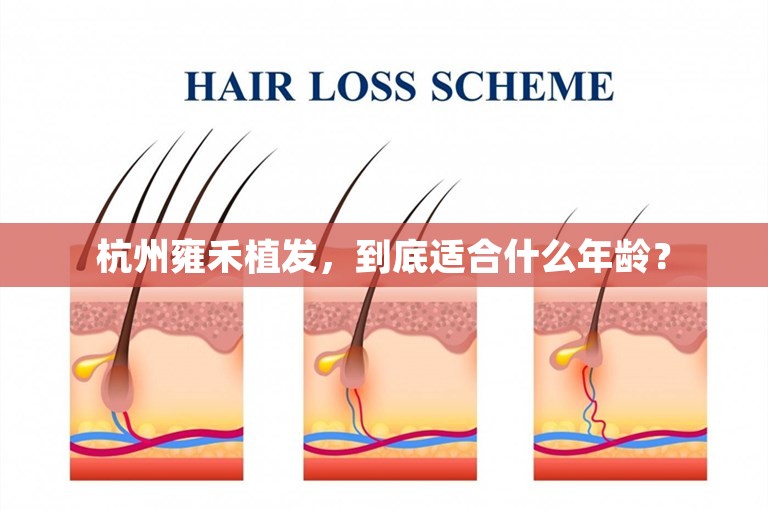 杭州雍禾植发，到底适合什么年龄？