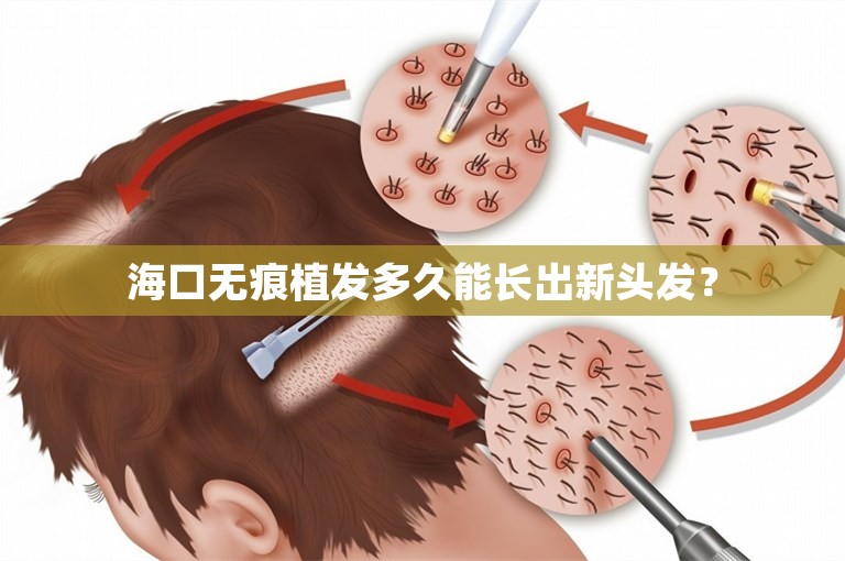 海口无痕植发多久能长出新头发？