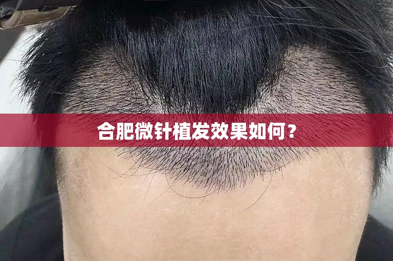 合肥微针植发效果如何？