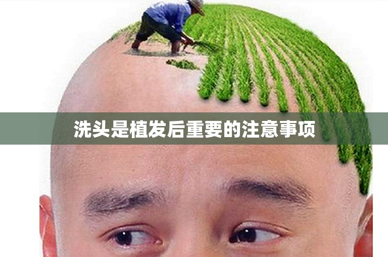 洗头是植发后重要的注意事项