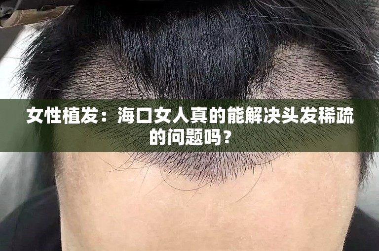 女性植发：海口女人真的能解决头发稀疏的问题吗？