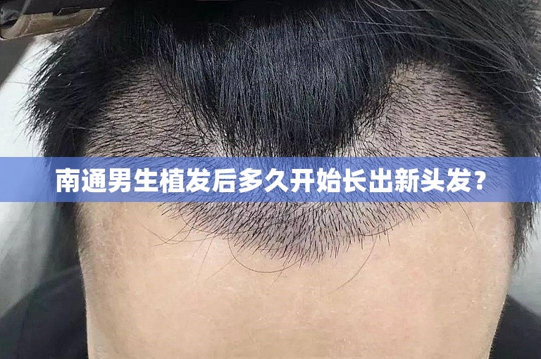 南通男生植发后多久开始长出新头发？