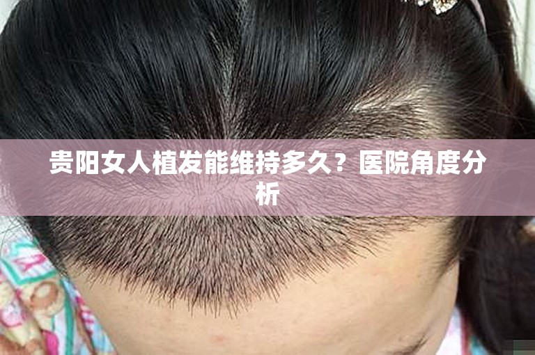 贵阳女人植发能维持多久？医院角度分析