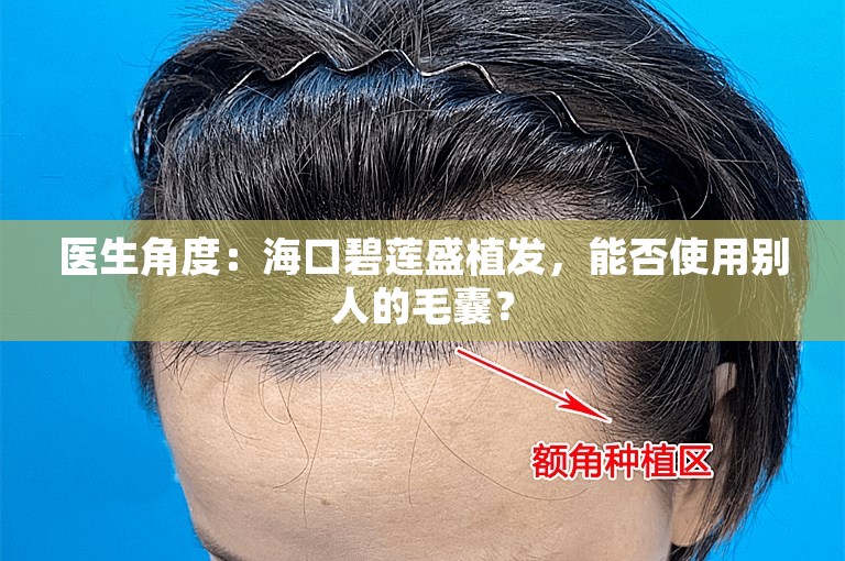 医生角度：海口碧莲盛植发，能否使用别人的毛囊？