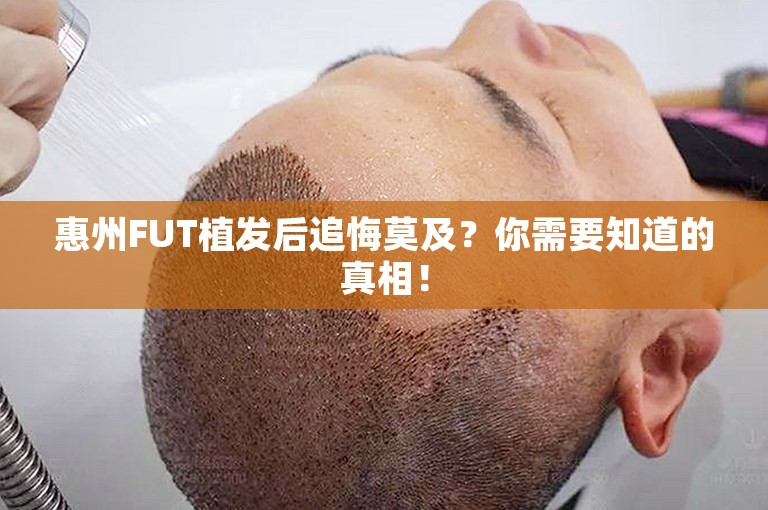 惠州FUT植发后追悔莫及？你需要知道的真相！