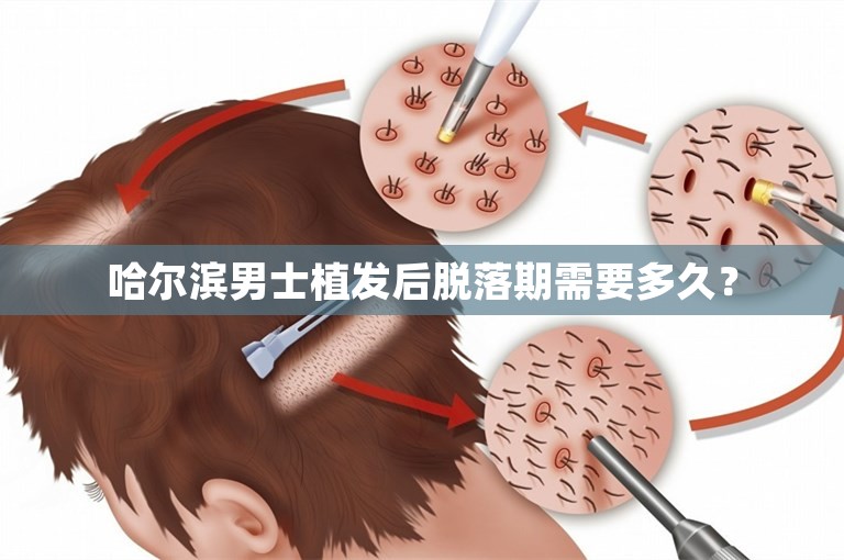 哈尔滨男士植发后脱落期需要多久？