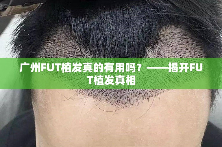 广州FUT植发真的有用吗？——揭开FUT植发真相