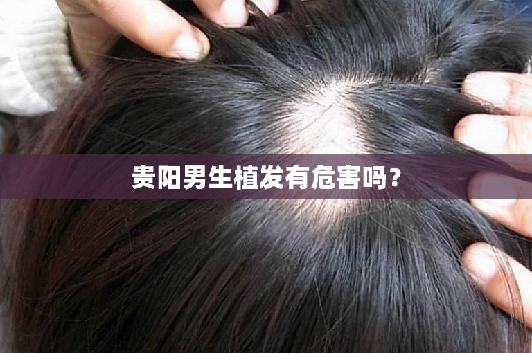 贵阳男生植发有危害吗？