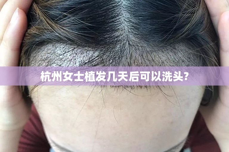 杭州女士植发几天后可以洗头?