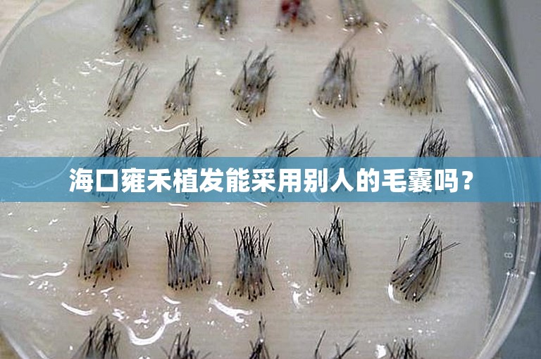 海口雍禾植发能采用别人的毛囊吗？