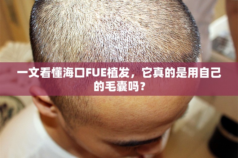 一文看懂海口FUE植发，它真的是用自己的毛囊吗？