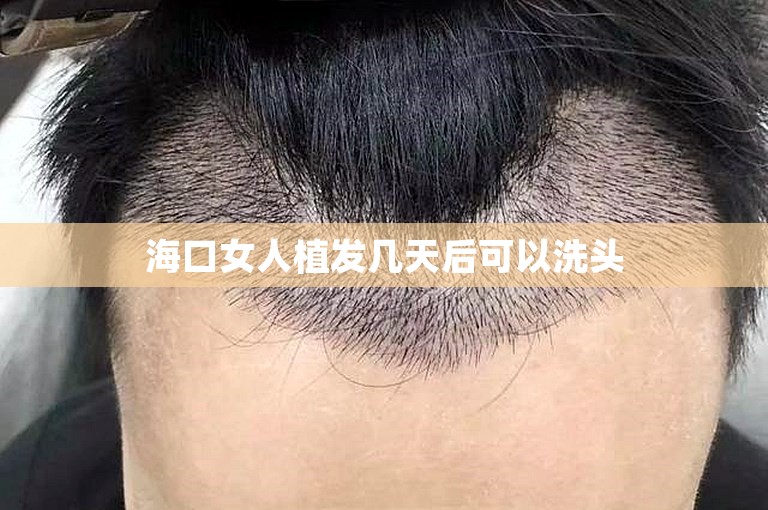 海口女人植发几天后可以洗头