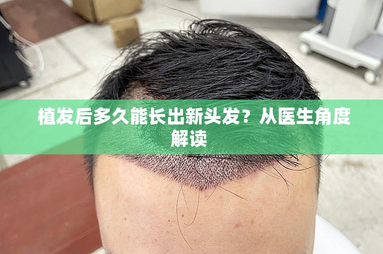  植发后多久能长出新头发？从医生角度解读 