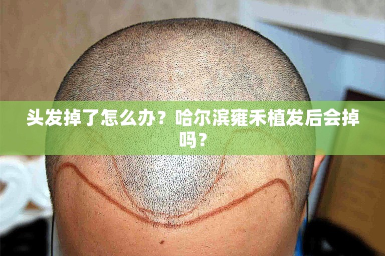 头发掉了怎么办？哈尔滨雍禾植发后会掉吗？