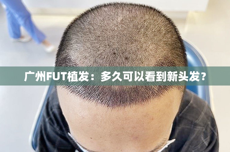 广州FUT植发：多久可以看到新头发？