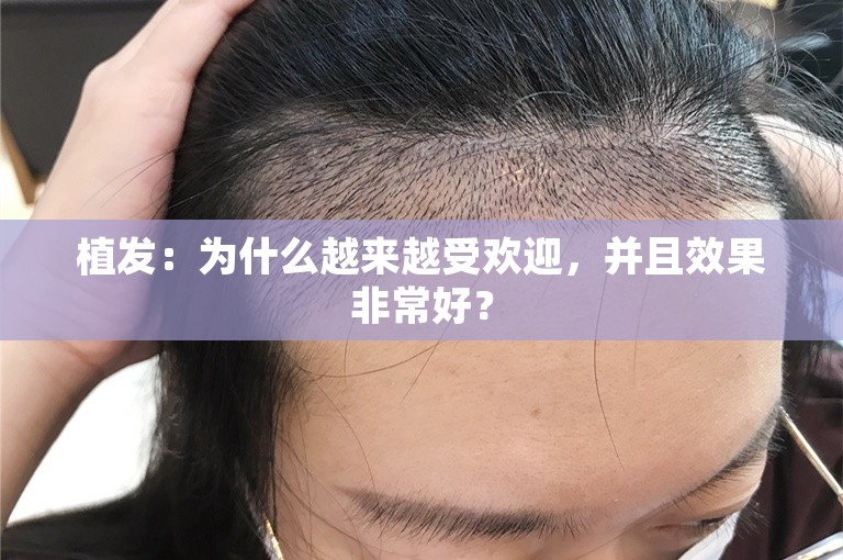 植发：为什么越来越受欢迎，并且效果非常好？