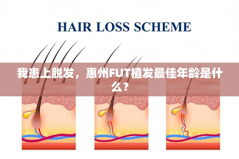 我患上脱发，惠州FUT植发最佳年龄是什么？