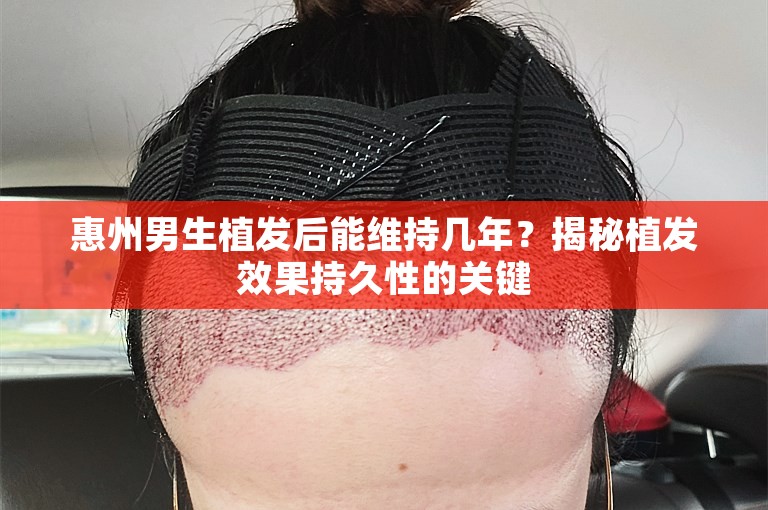 惠州男生植发后能维持几年？揭秘植发效果持久性的关键