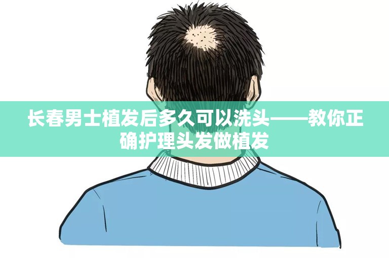 长春男士植发后多久可以洗头——教你正确护理头发做植发