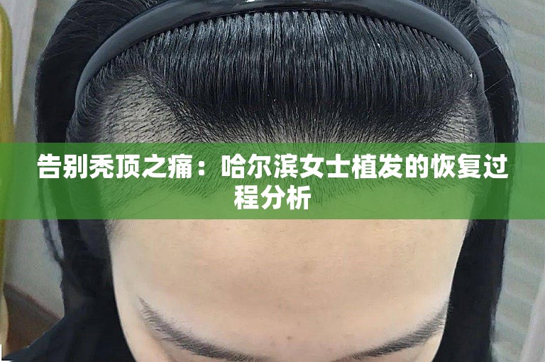 告别秃顶之痛：哈尔滨女士植发的恢复过程分析