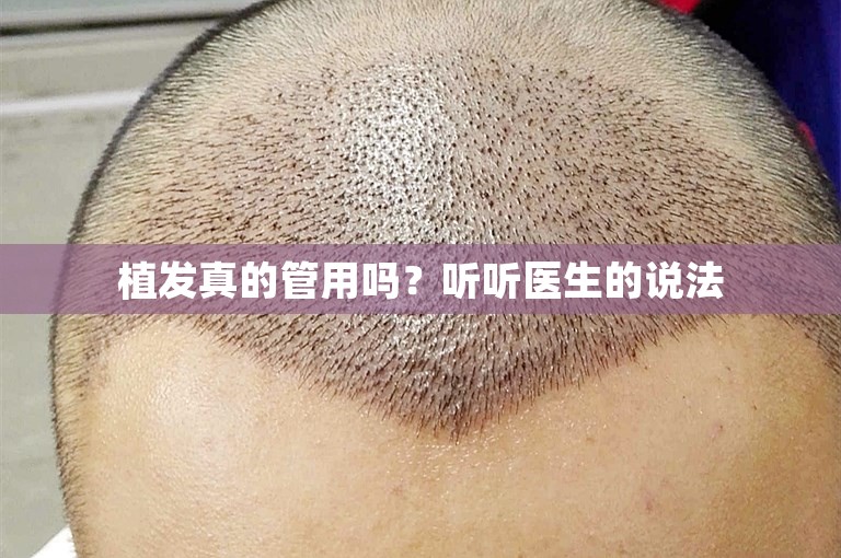 植发真的管用吗？听听医生的说法