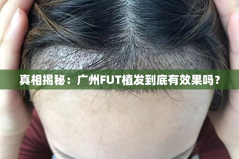 真相揭秘：广州FUT植发到底有效果吗？