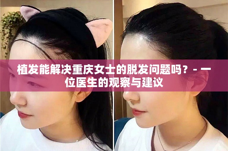 植发能解决重庆女士的脱发问题吗？- 一位医生的观察与建议