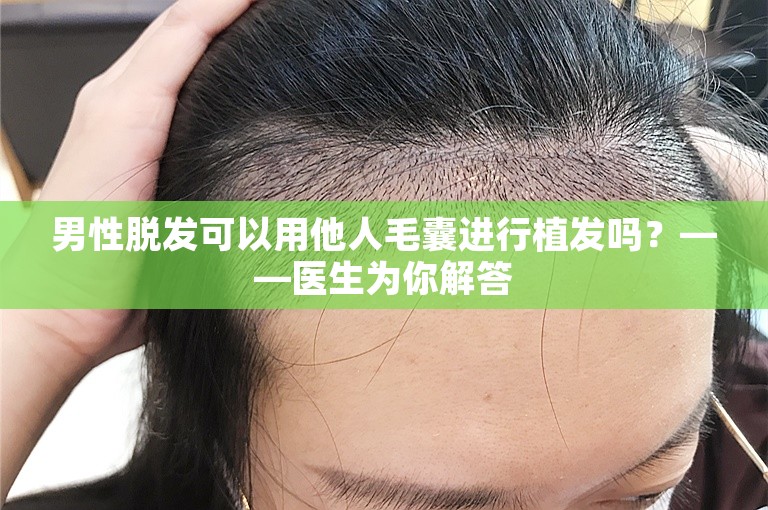 男性脱发可以用他人毛囊进行植发吗？——医生为你解答