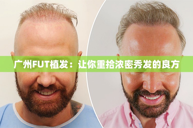 广州FUT植发：让你重拾浓密秀发的良方